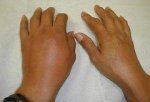 gout 2.jpeg