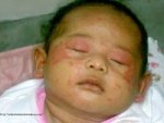 eczema 1.jpg